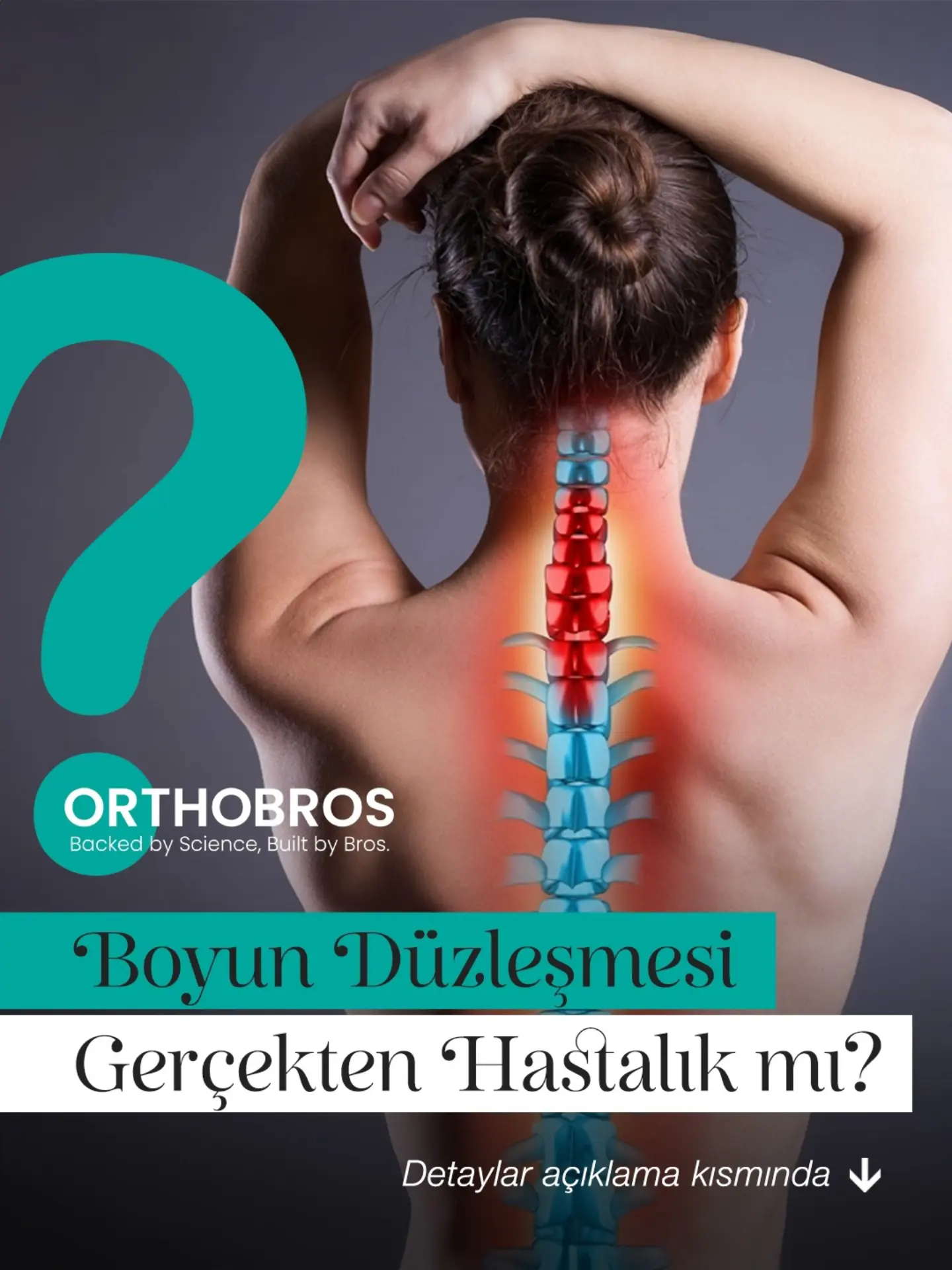 BOYUN DÜZLEŞMESİ GERÇEKTEN BİR HASTALIK MI?

MR veya röntgen raporlarında sıkça şu ifadeyle karşılaşırız: “Servikal lordozda düzleşme izlenmiştir.” Peki bu ifade ne anlama gelir?

Boyun düzleşmesi, boyun omurgasının doğal eğriliğinde azalma olduğunu anlatan bir görüntüleme bulgusudur. Tek başına bir hastalık tanısı değildir. Boyun omurgasının dizilimi kişiden kişiye değişebilir; eğrilikteki azalma da her zaman ağrıyla doğrudan ilişkili değildir.

Bu yüzden değerlendirilmesi gereken yalnızca görüntü değil, kişinin şikâyetleri ve muayene bulgularıdır. Ağrının şiddeti ve süresi, hareket kısıtlılığı, günlük yaşama etkisi ve varsa nörolojik belirtiler birlikte ele alınır. Görüntüleme raporundaki tek bir ifade, kendi başına tedavi kararı verdirmez.

Boyun ağrısında uygun hareketi sürdürmek ve kişiye göre planlanan egzersizler, güncel klinik öneriler arasında yer alır.

Kısacası: Raporda “boyun düzleşmesi” yazması, tek başına hasta olduğunuz anlamına gelmez. Tedavi rapora değil, kişiye göre planlanır.

Detaylı bilgi ve sipariş için:
📞 0549 155 4141
🌐 orthobros.com.tr

#sağlıkbilgisi #bilgiköşesi #ağrıbilimi #boyundüzleşmesi #boyunağrısı